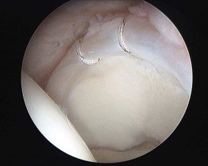 arthroscopic-repair-labral-tear-300x240.jpg