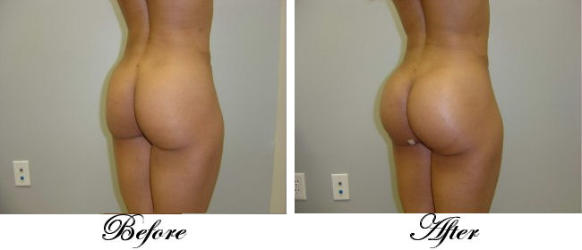 butt-augmentation-with-implant.jpg