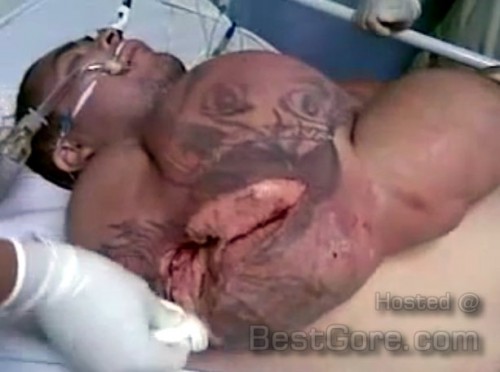 synthol+abuser+anabolic-steroids-side-effects-nasty-open-muscle-rupture-.jpg
