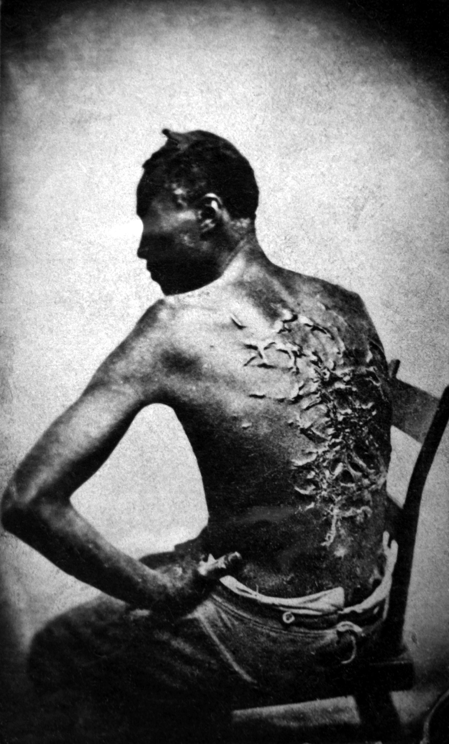 Cicatrices_de_flagellation_sur_un_esclave.jpg