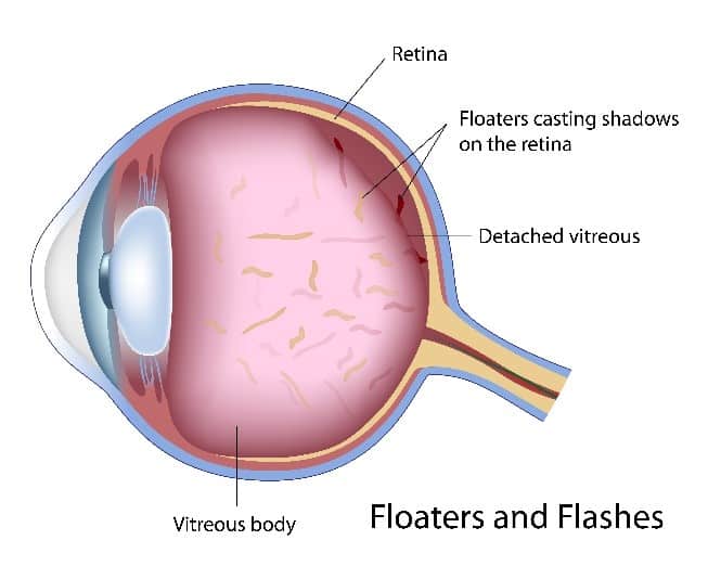 vitreous-detachment-1.jpg
