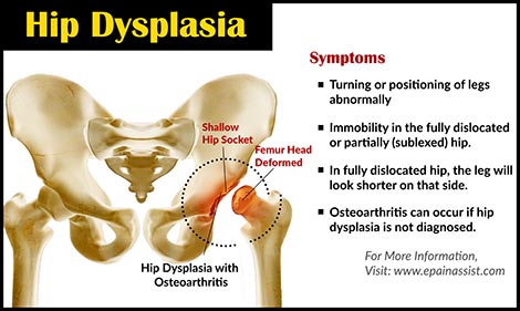 hip-dysplasia-symtoms.jpg