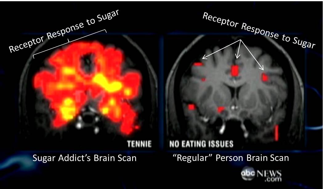 sugar-brain1.jpg