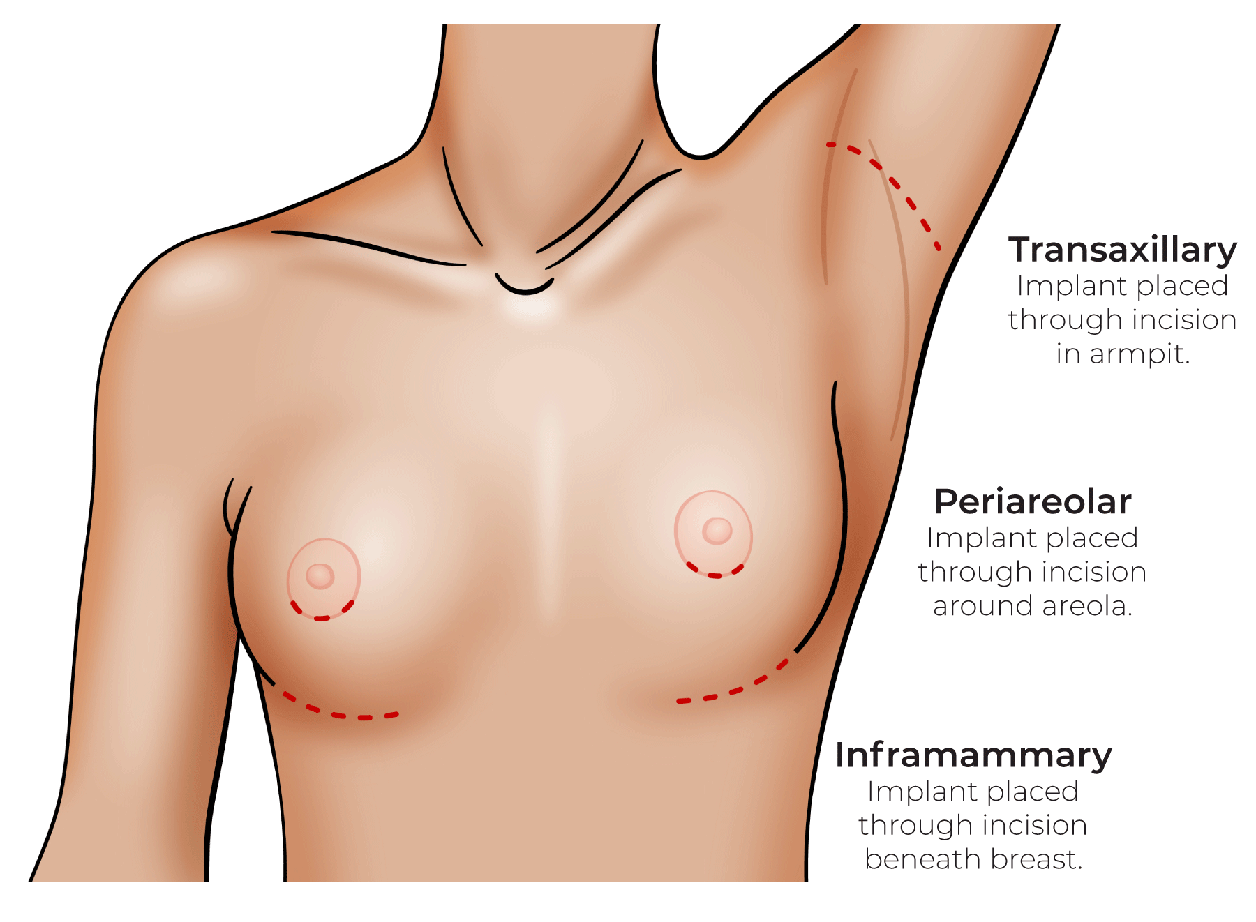 Breast Augmentation Scars: What to Expect | Scottsdale AZ Plastic Surgeon