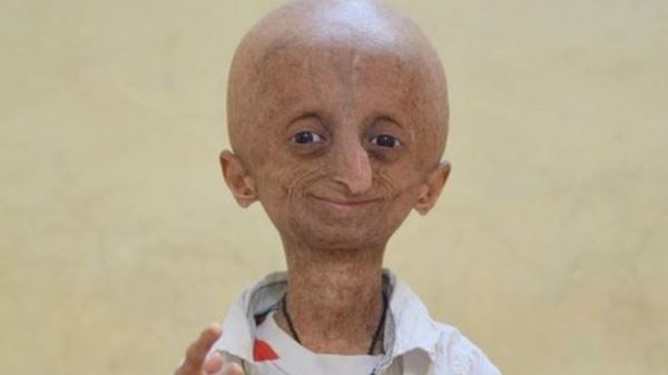 Progeria.jpg