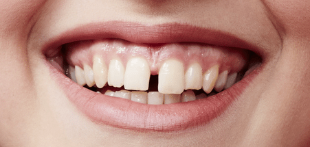 gap-tooth-smile-plano-tx-cosmetic-dentist.png