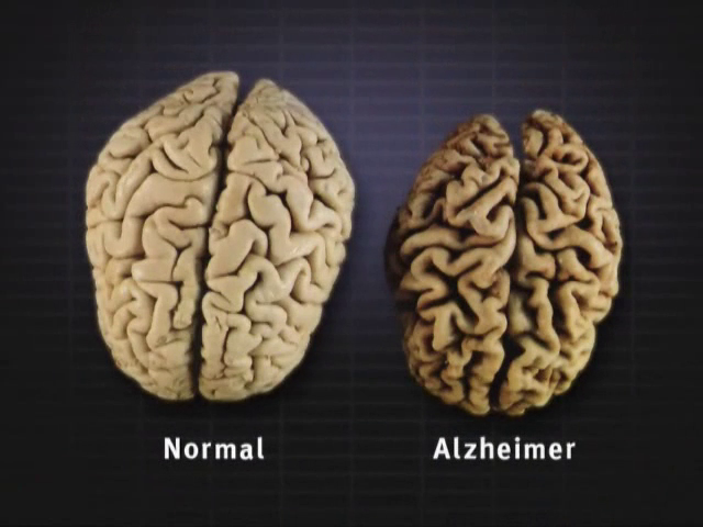dementia-brain-changes-thumb.png