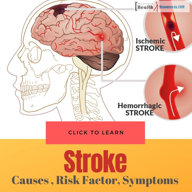 Causes-Of-Stroke.jpg